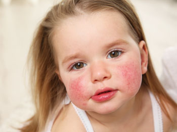 Dermatite Atópica (DA) - Blog Dra Izabella Rached